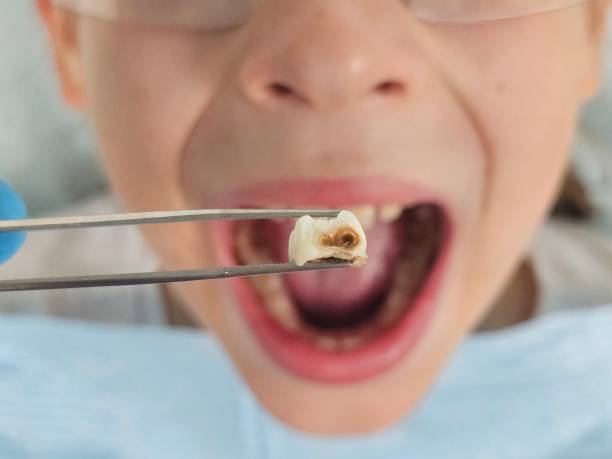 Best Emergency Gum Treatment in Orchard Mesa, CO